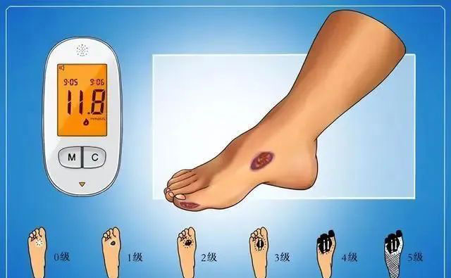 【警惕】一次小烫伤,差点被截肢!这个教训太深刻(图1) 1.jpg