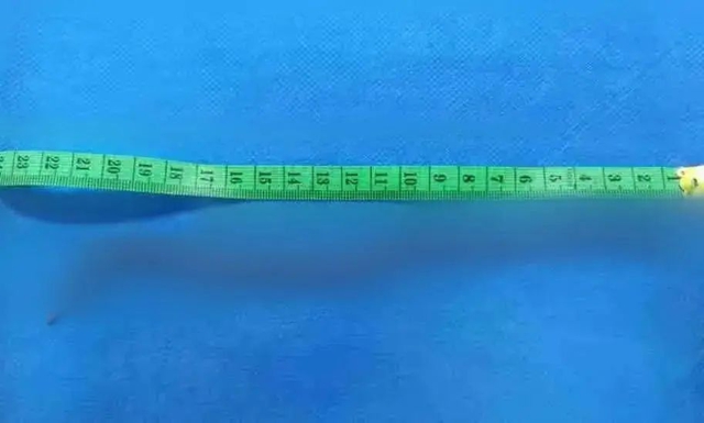 生菜卷烤肉藏“活虫”？女子体内取出20cm蛔虫