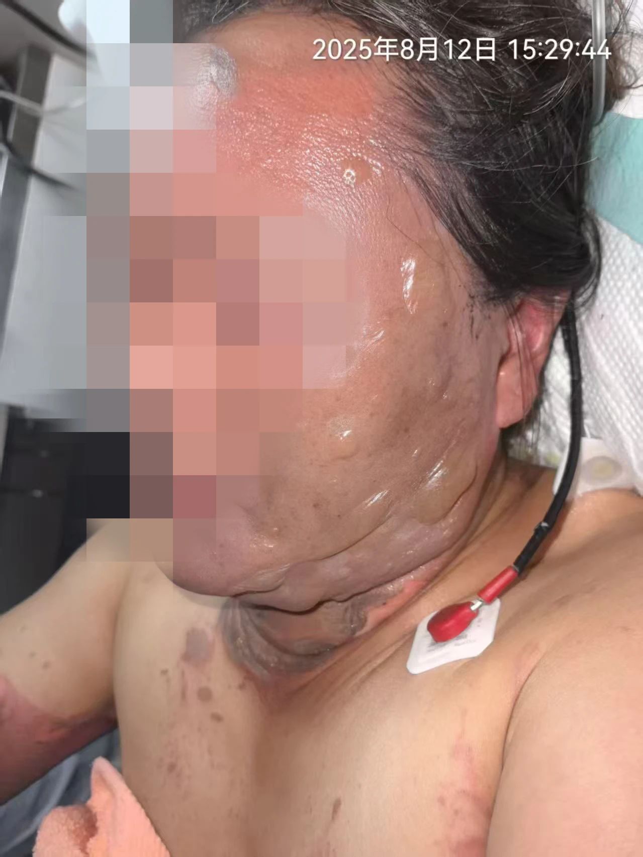 滚烫的热油泼满全身，女子被严重烧伤