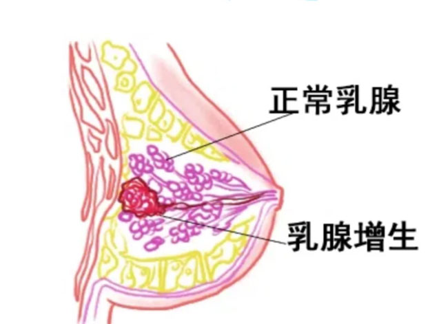 【科普】乳腺癌最喜欢这几类人,快看下有您吗?(图4) 4.jpg