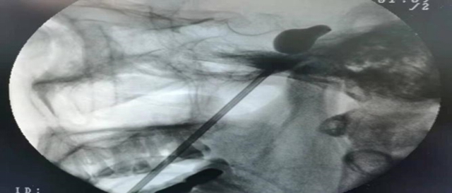 太痛!老人遭疼痛折磨多年,微球囊压迫术让顽痛退!退!退!(图5) 64005.jpg