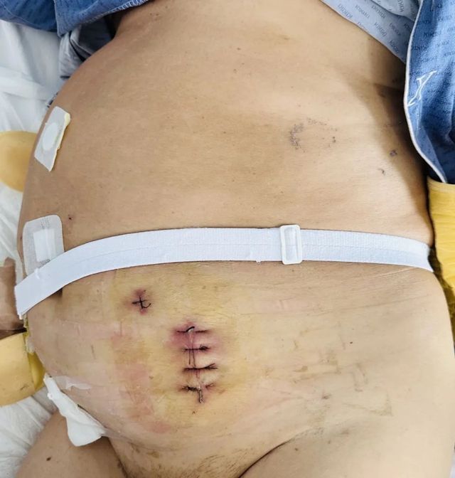 男子肠道被“堵死”,切除肛门?(图1) 6401.jpg