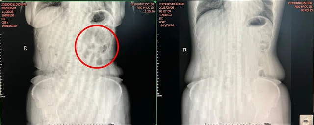 拒绝手术的她,依靠中医闯过生命难关!(图2) 中2.jpg