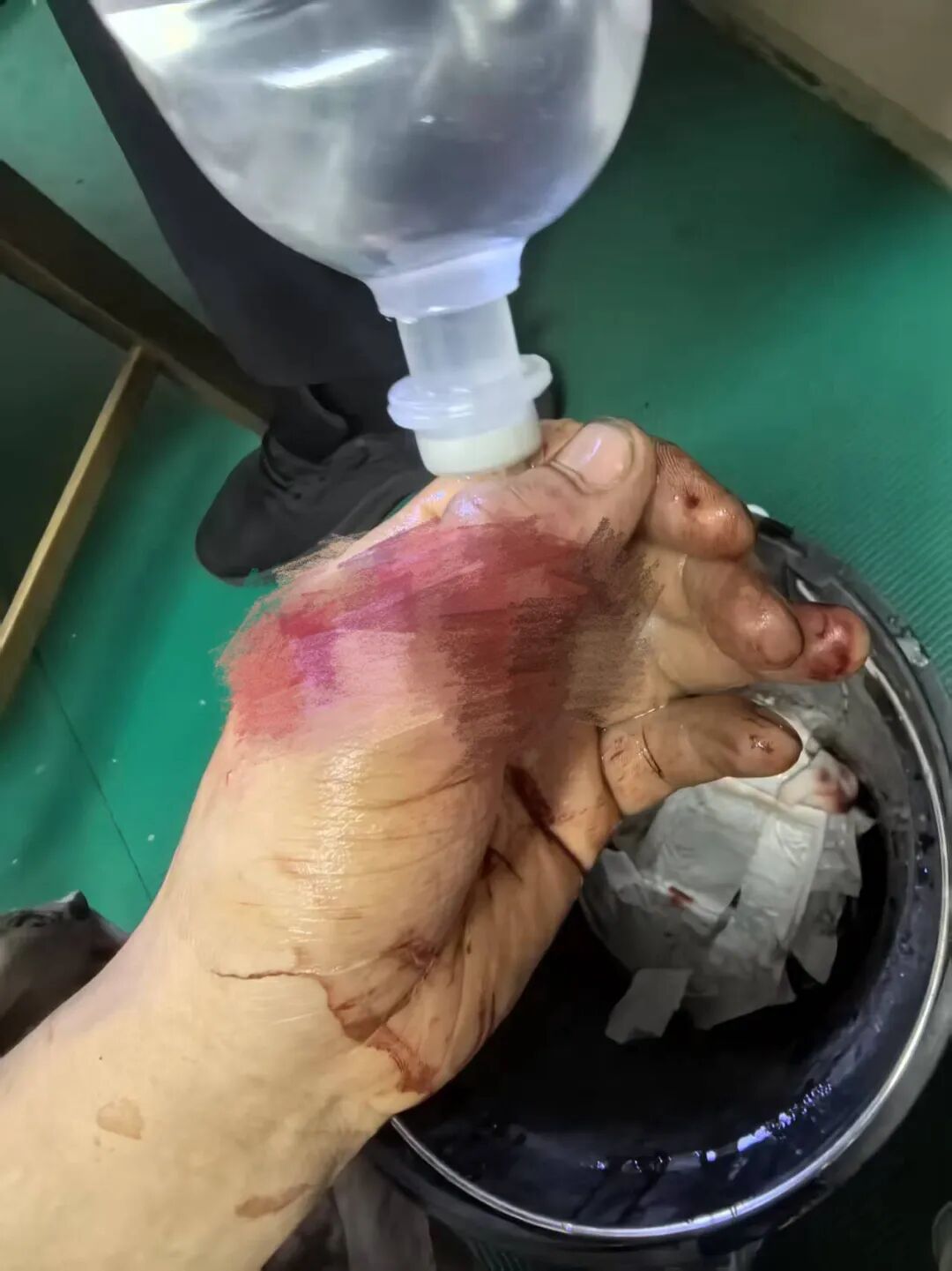 点赞!男子从非洲到泸州,帅哥医生们成功接骨(图1) 非洲1.jpg