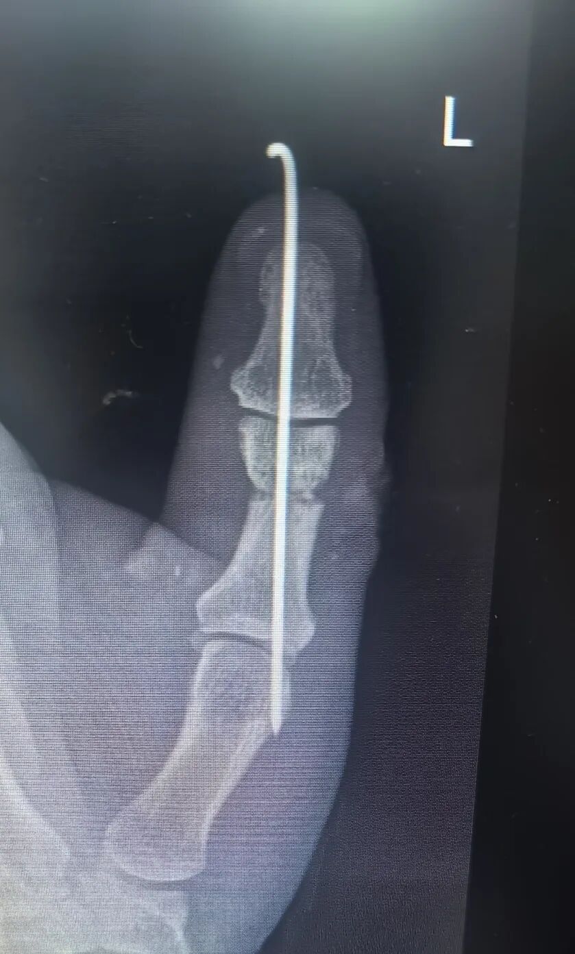 点赞!男子从非洲到泸州,帅哥医生们成功接骨(图3) 非洲4.jpg