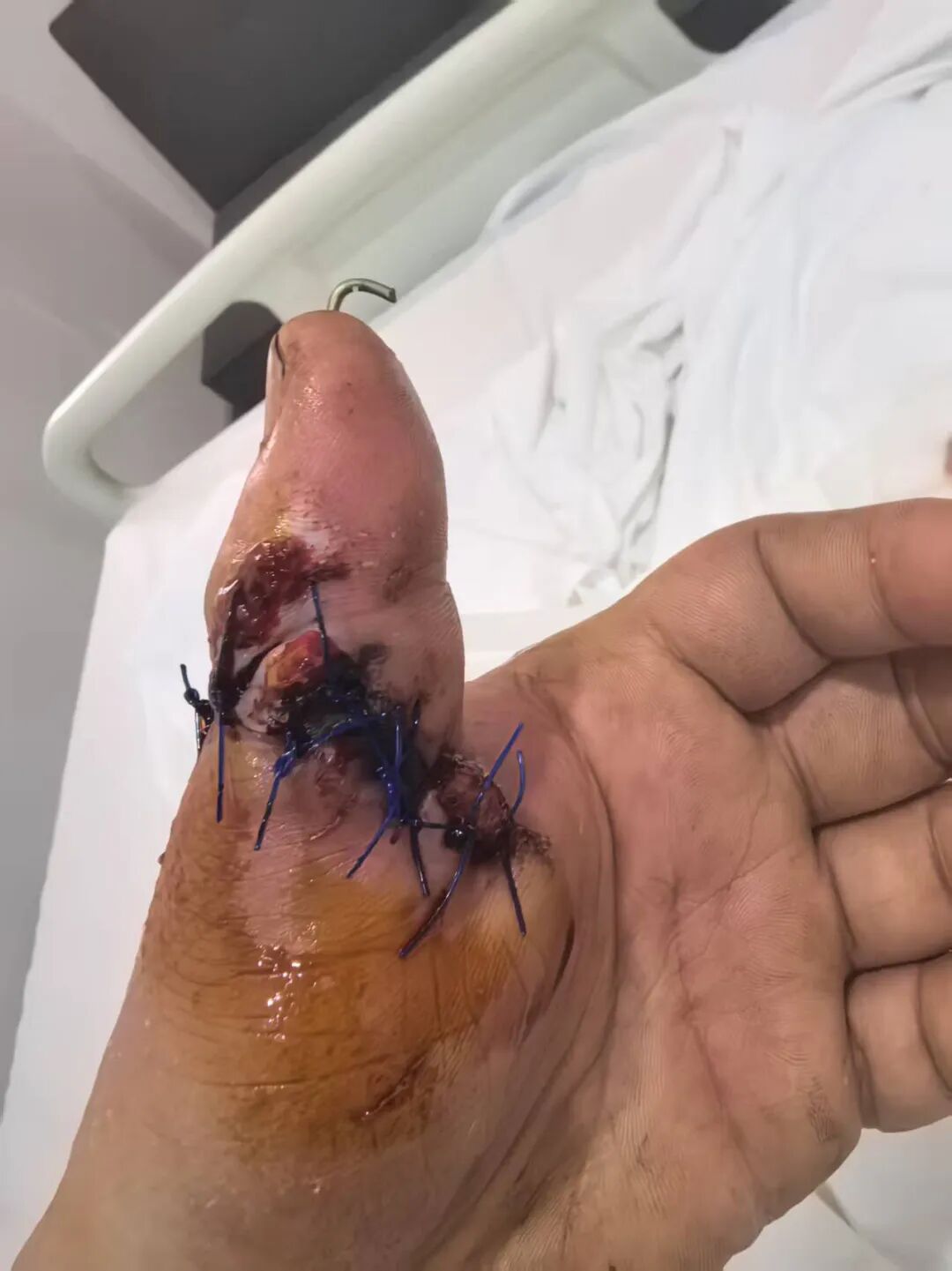 点赞!男子从非洲到泸州,帅哥医生们成功接骨(图5) 非洲6.jpg