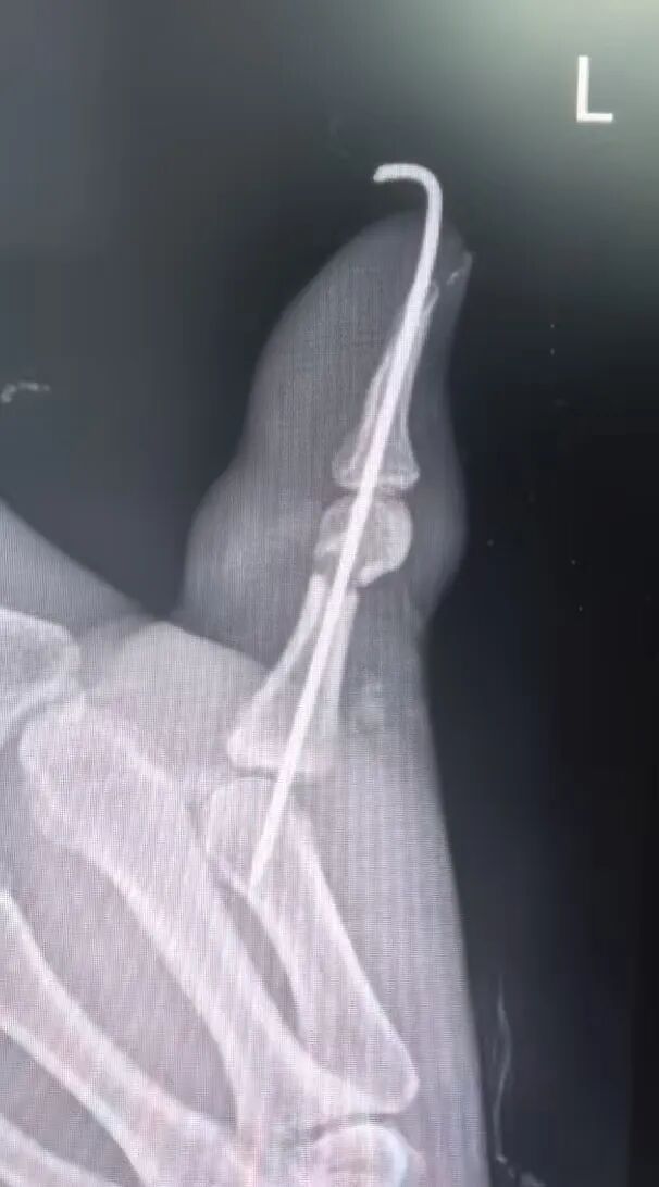 点赞!男子从非洲到泸州,帅哥医生们成功接骨(图4) 非洲5.jpg