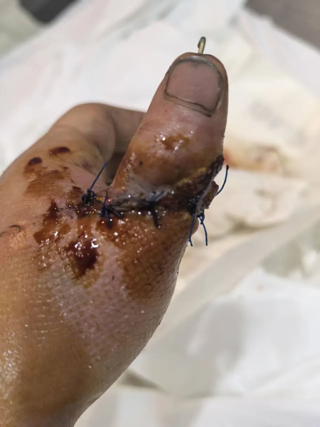 点赞!男子从非洲到泸州,帅哥医生们成功接骨(图6) 非洲7.jpg