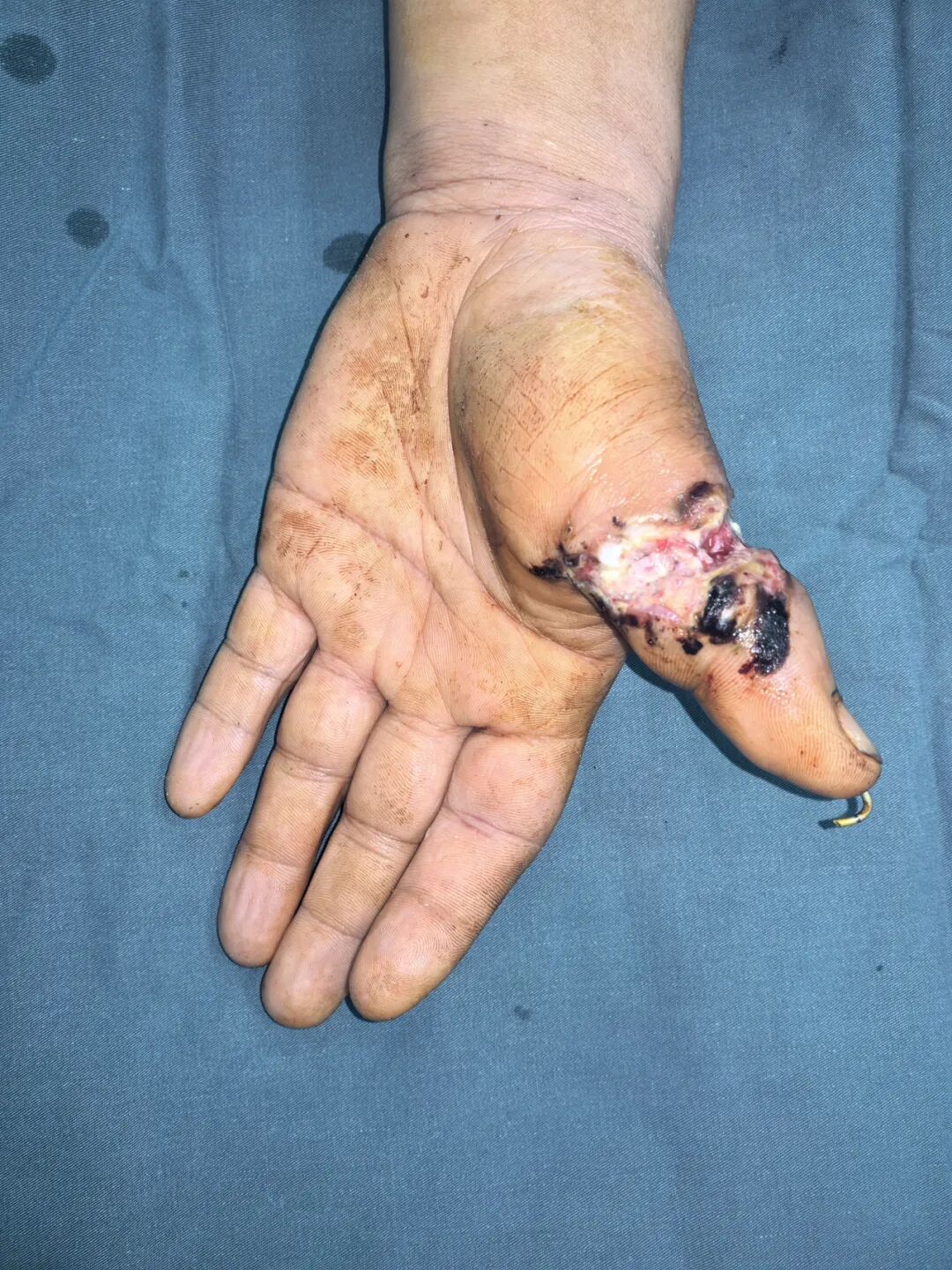 点赞!男子从非洲到泸州,帅哥医生们成功接骨(图7) 非洲8.jpg