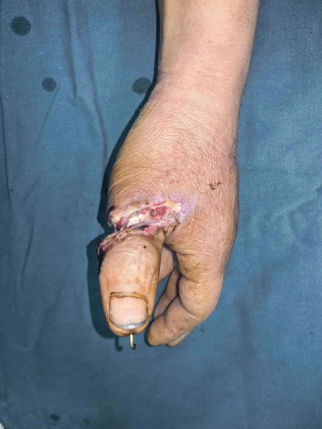 点赞!男子从非洲到泸州,帅哥医生们成功接骨(图8) 非洲9.jpg