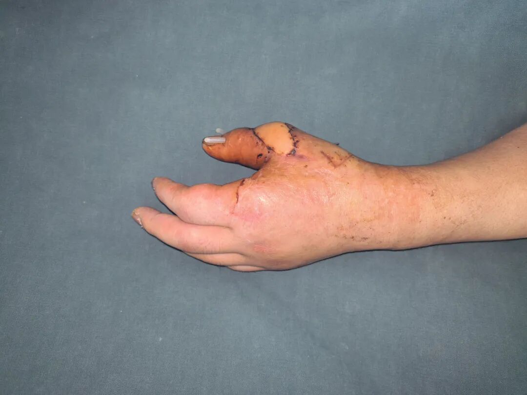 点赞!男子从非洲到泸州,帅哥医生们成功接骨(图12) 非洲13.jpg