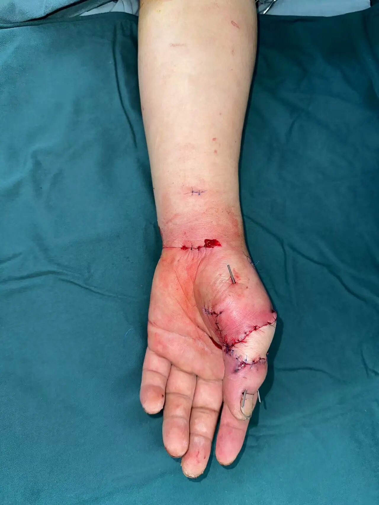 点赞!男子从非洲到泸州,帅哥医生们成功接骨(图10) 非洲11.jpg