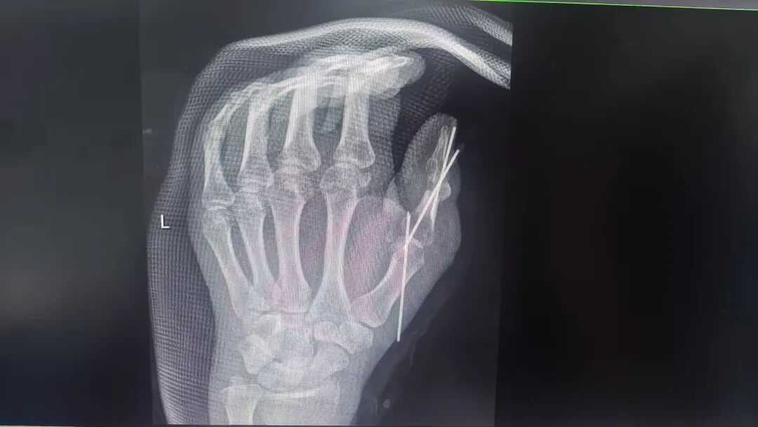 点赞!男子从非洲到泸州,帅哥医生们成功接骨(图11) 非洲12.jpg