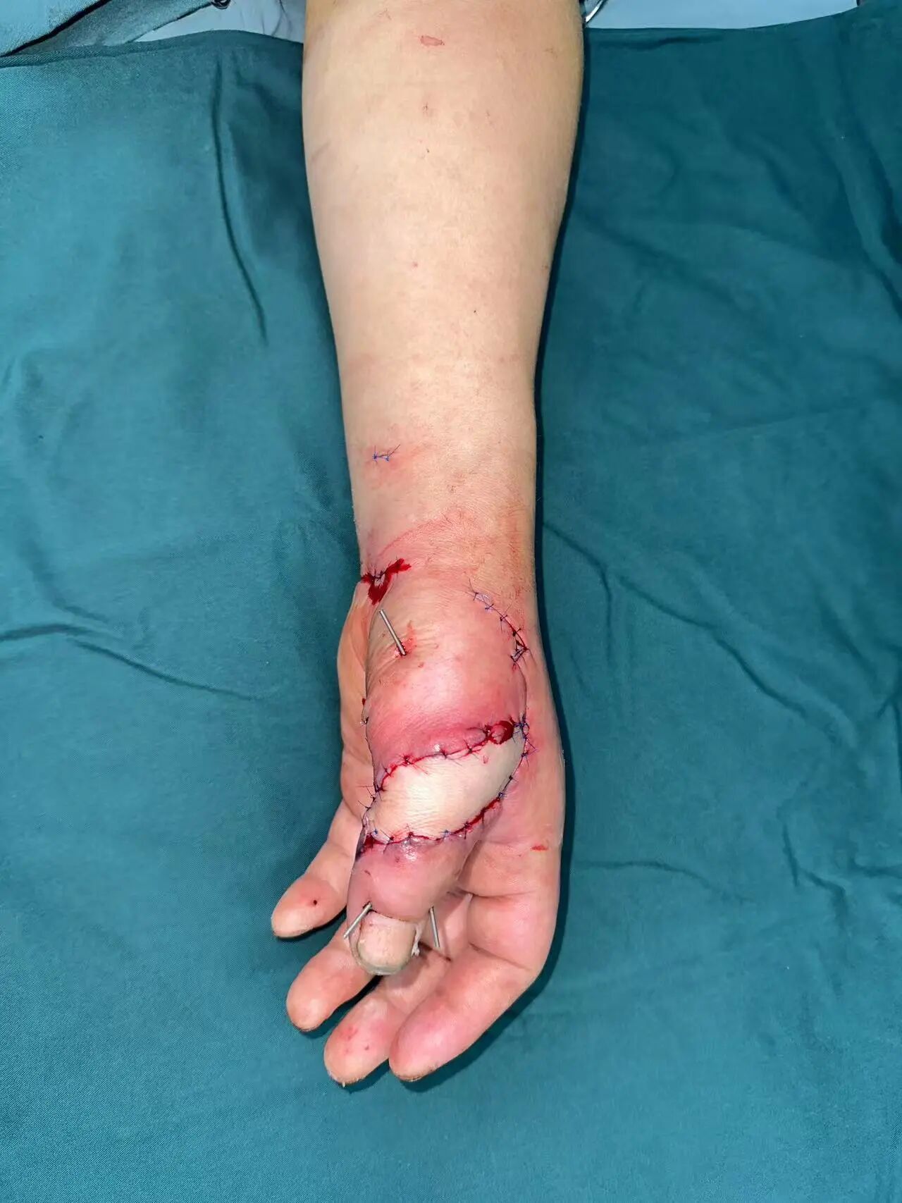 点赞!男子从非洲到泸州,帅哥医生们成功接骨(图9) 非洲10.jpg