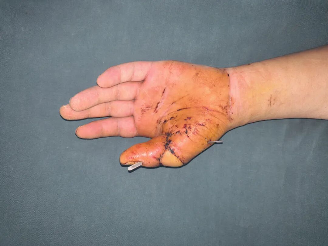 点赞!男子从非洲到泸州,帅哥医生们成功接骨(图13) 非洲14.jpg