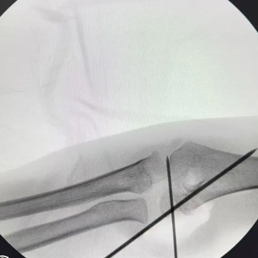 刚开学,5娃就组团骨折……(图4) 4.jpg