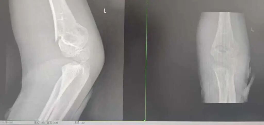 刚开学,5娃就组团骨折……(图3) 3.jpg