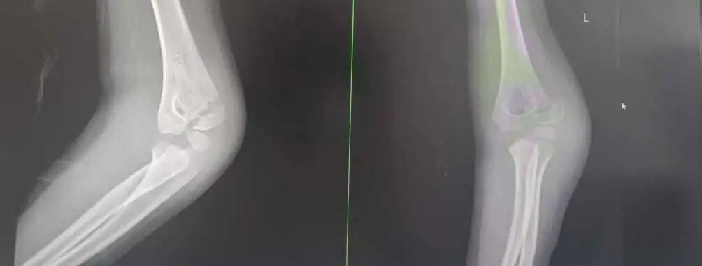 刚开学,5娃就组团骨折……(图1) 1.jpg