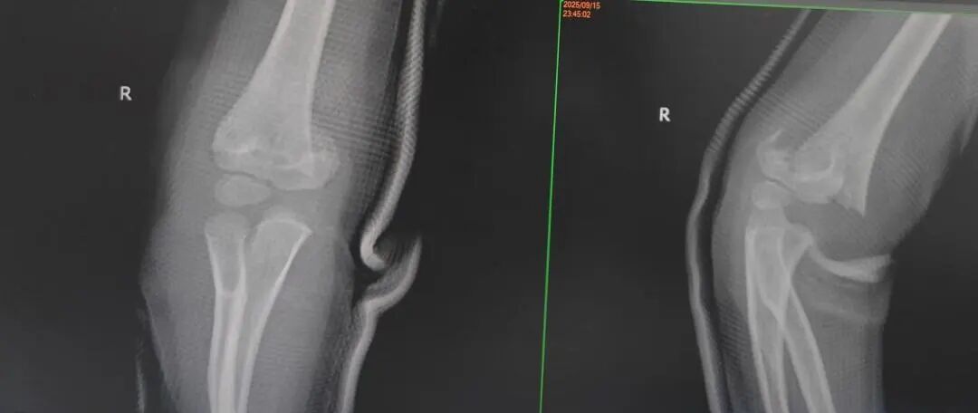 刚开学,5娃就组团骨折……(图2) 2.jpg