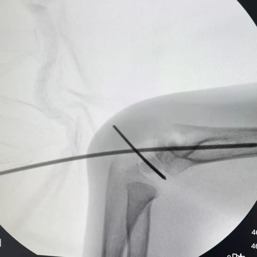 刚开学,5娃就组团骨折……(图5) 5.jpg