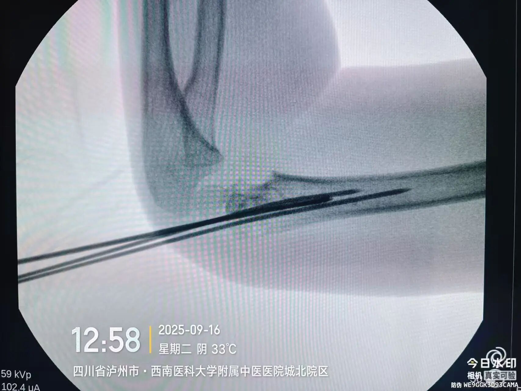 刚开学,5娃就组团骨折……(图7) 7.jpg