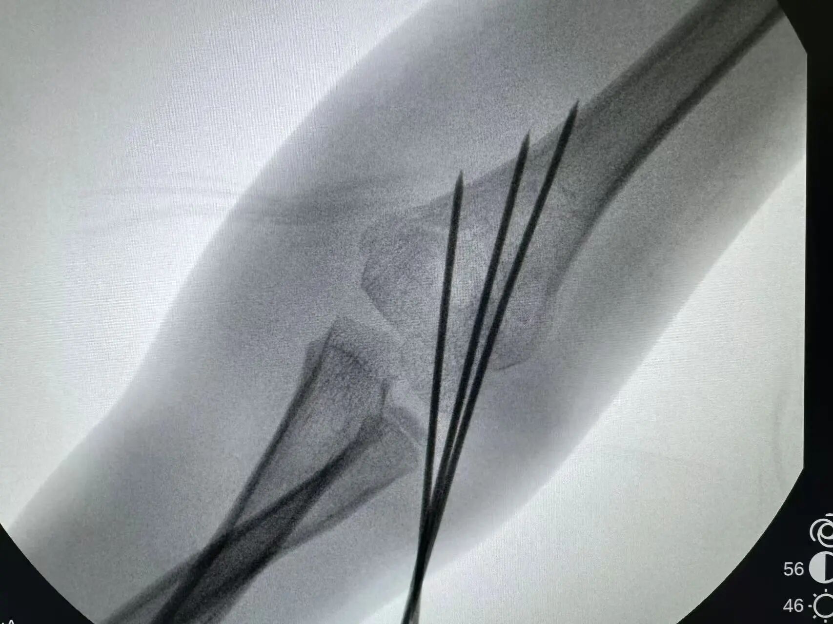 刚开学,5娃就组团骨折……(图8) 8.jpg