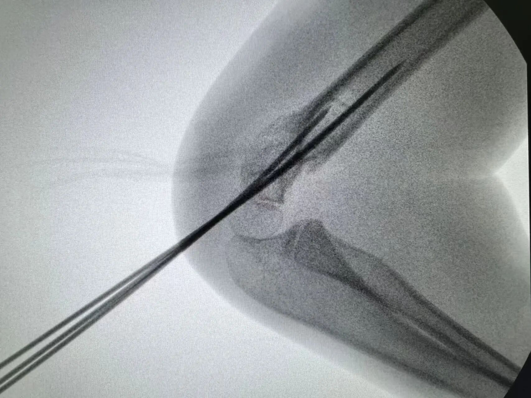 刚开学,5娃就组团骨折……(图9) 9.jpg