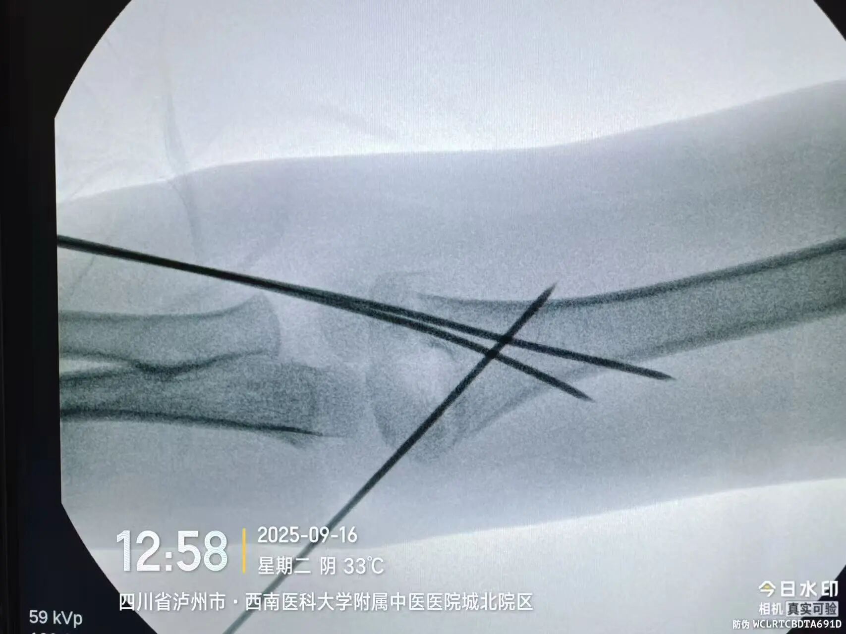 刚开学,5娃就组团骨折……(图6) 6.jpg