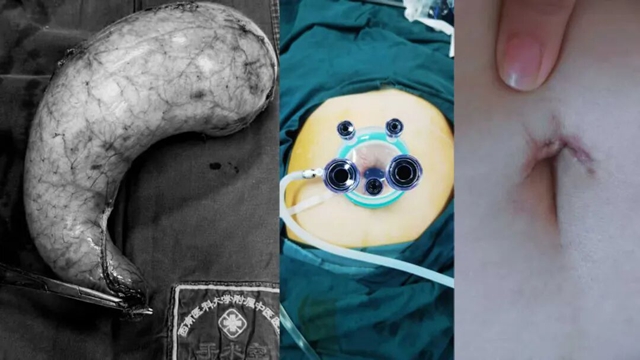 泸州女子身高158cm,重达160斤!切胃……(图2) 6402.jpg