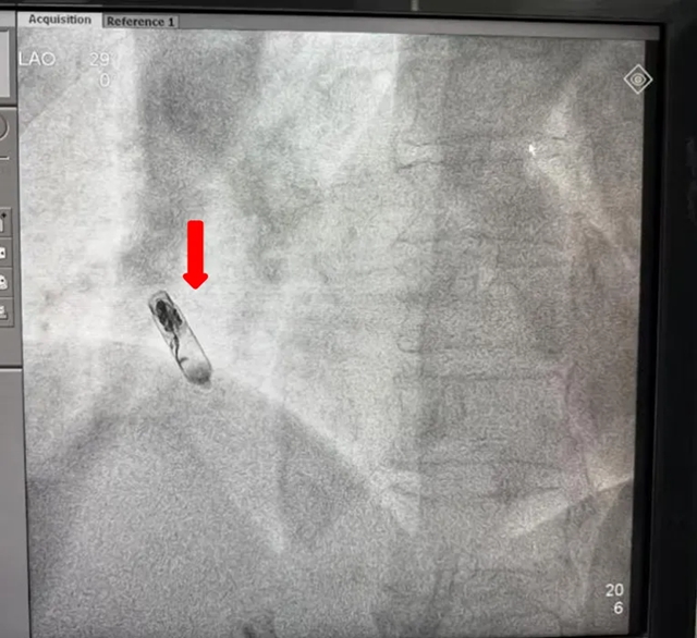 八旬老人心脏竟被“钉入”智能螺丝,这究竟是何操作?(图5) 5.jpg