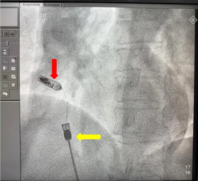 八旬老人心脏竟被“钉入”智能螺丝,这究竟是何操作?(图4) 4.jpg