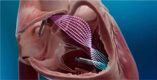 八旬老人心脏竟被“钉入”智能螺丝,这究竟是何操作?(图6) 6.jpg