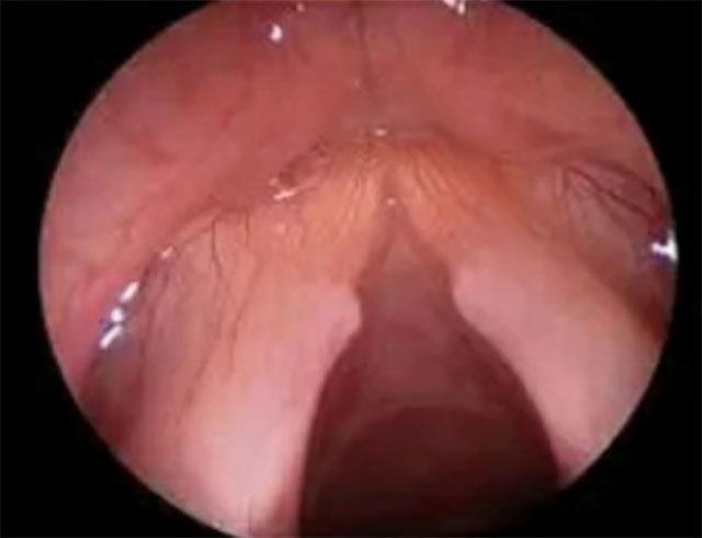 声音哑了别硬扛!有可能是癌(图3) 3.jpg
