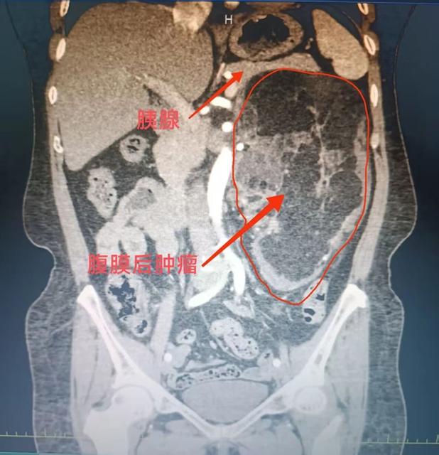19cm“腹内炸弹”比拳头大2倍，5小时抢回命！