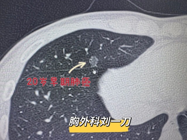 “不医了”......20岁泸州小伙确诊肺癌,两天就出院(图1) 1.jpg