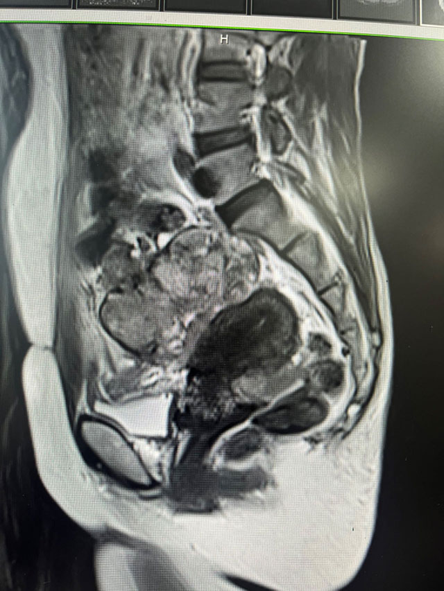 肚子一天天变大，她以为是“发福”，竟确诊癌症晚期！