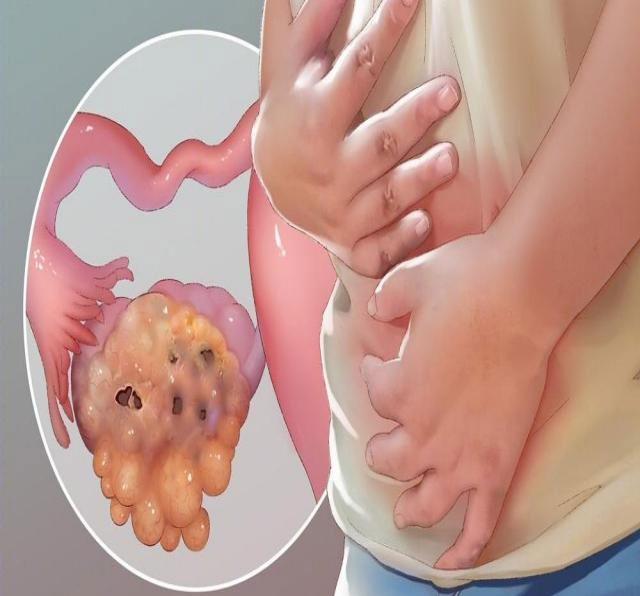 肚子一天天变大,她以为是“发福”,竟确诊癌症晚期!(图8) 8.jpg