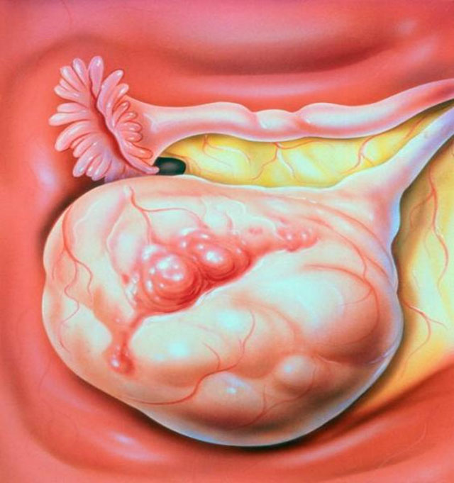 肚子一天天变大,她以为是“发福”,竟确诊癌症晚期!(图7) 7.jpg