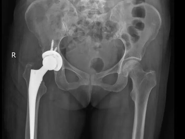 泸州嬢嬢组团摔倒,接连换骨头(图3) 3.jpg