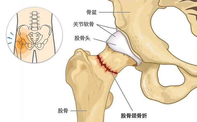 泸州嬢嬢组团摔倒,接连换骨头(图5) 5.jpg