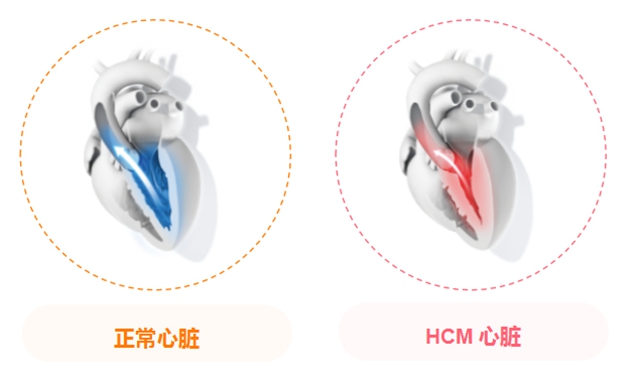 18岁少女！心脏“长胖”