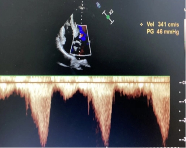 18岁少女!心脏“长胖”(图3) 胖3.jpg
