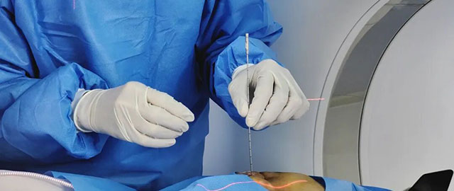 泸州16岁少女!眼眶后长出恶性肿瘤(图8) 8.jpg