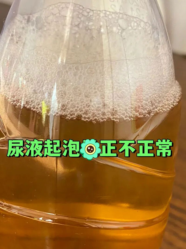 泸州男子尿酸500+无症状？直到尿中带泡，肾脏已被……