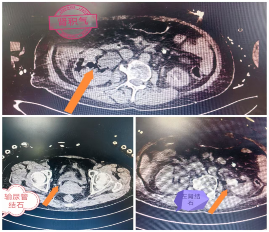 泸州女子肾脏疯狂“发酵”！产生大量气体……