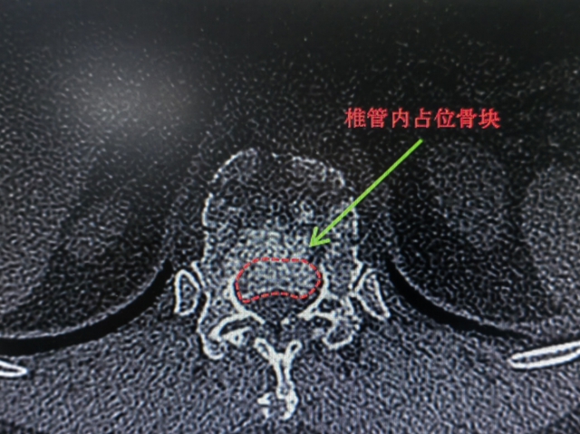 泸州女士爬树摘桂圆，遭得惨……