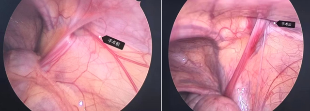 5岁小男孩上厕所、跑步时内脏会凸出来