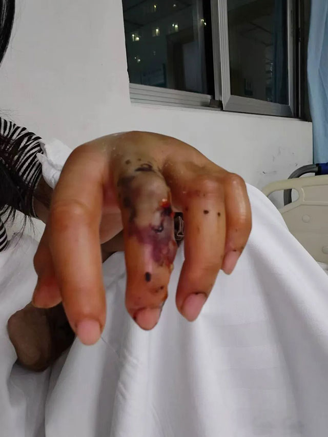 多人被毒蛇咬伤，乌黑、肿胀、血泡、坏死...还有成都来的