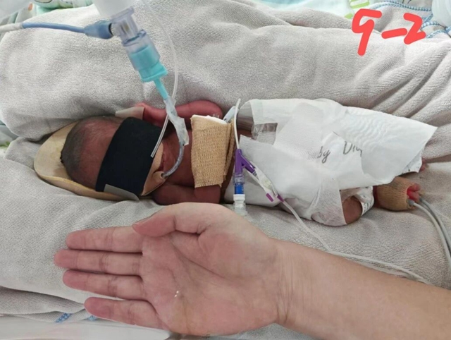 一斤七两的娃，想活下来