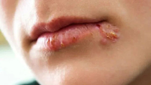 嘴上起水泡又痒又疼？不是上火，可能是这种终身潜伏的病毒，会传染！